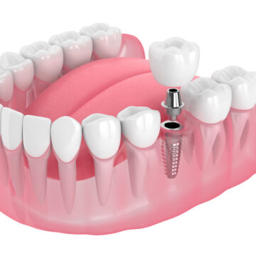 Dental Implants