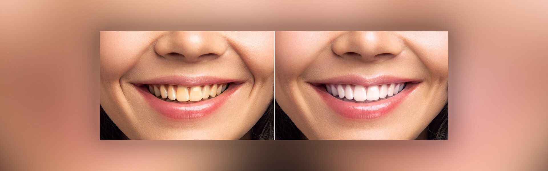 Teeth Whitening in Richmond, TX